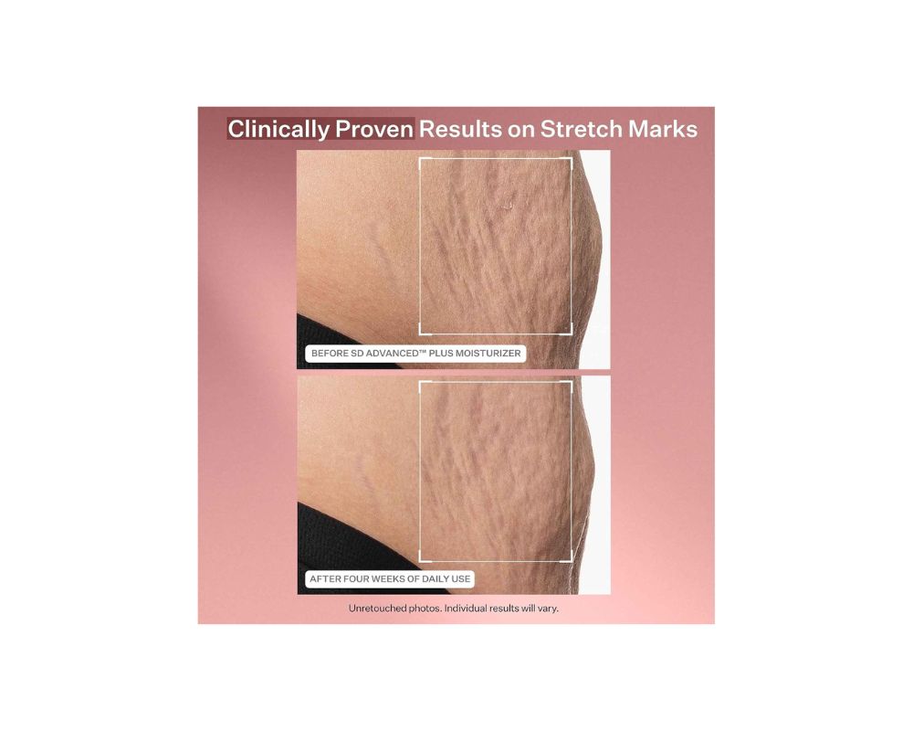 StriVectin SD Advanced™ PLUS Intensive Moisturizer for Stretchmarks and Wrinkles - YesMegastore