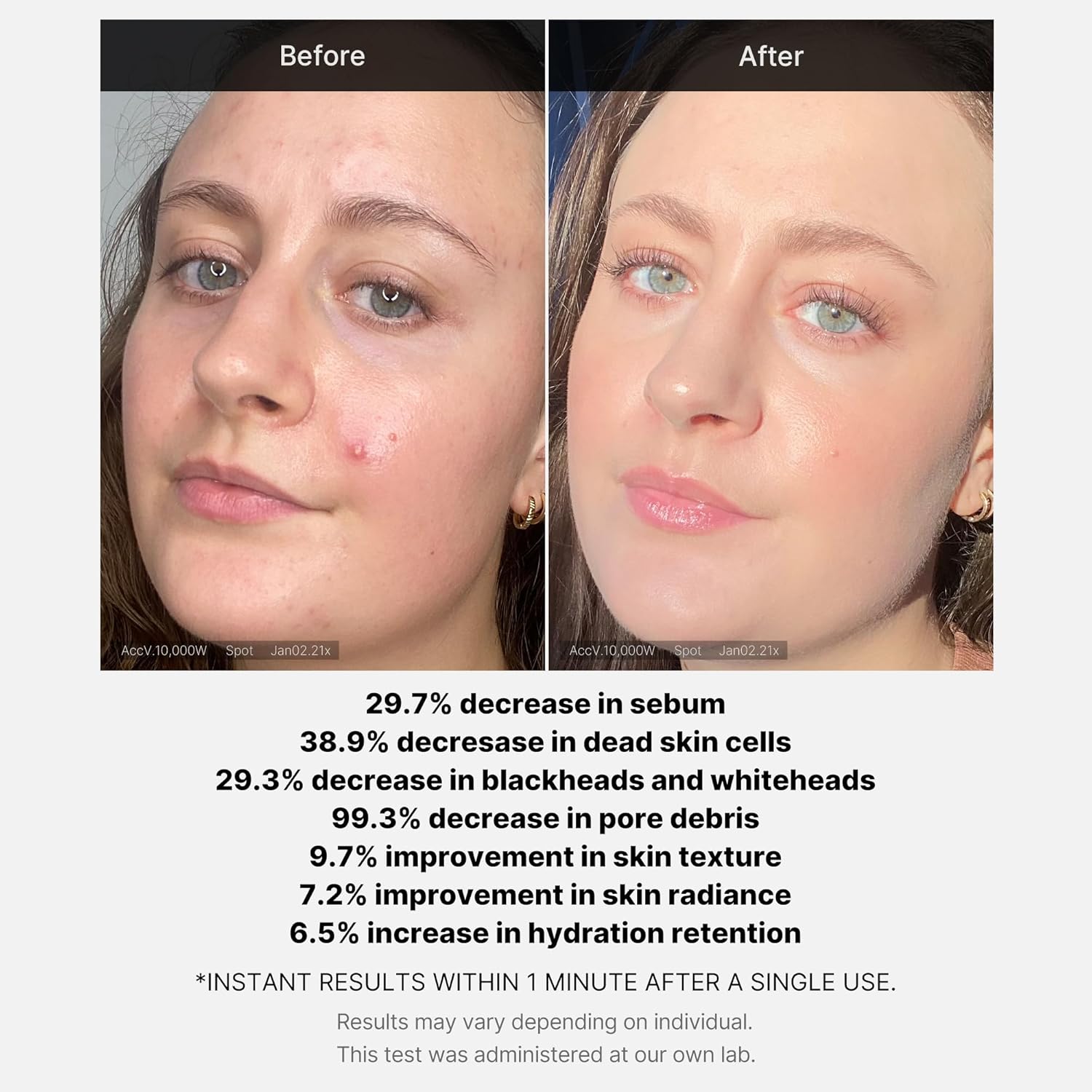 Medicube Red Acne Succinic Acid Peel – 40g